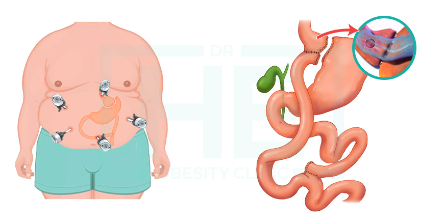 bypass gastrique laparoscopique